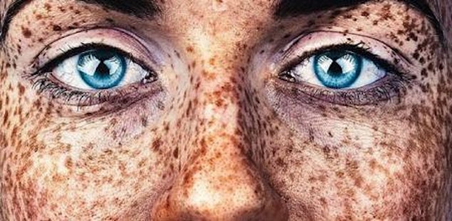 ¿Por qué surgen las pecas?